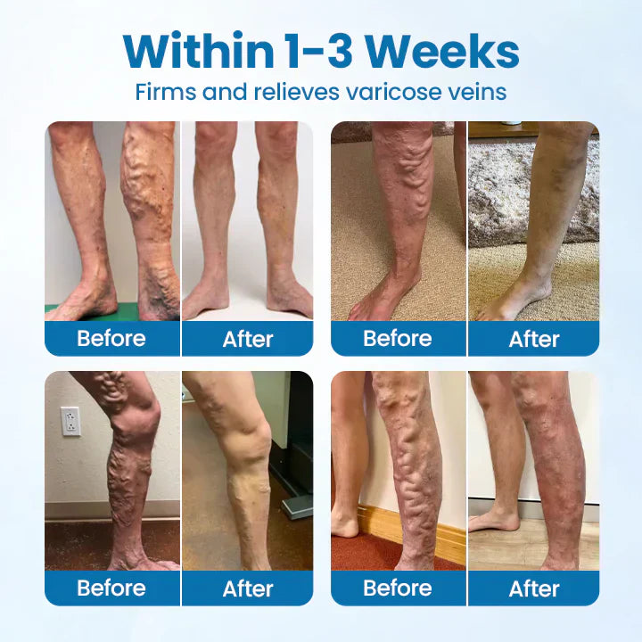 💪Ourlyard® VeinGuard Herbal Spray-✅ Clinically proven to eliminate varicose veins in just 7 days! (🔥Limited Time 80% OFF🔥)