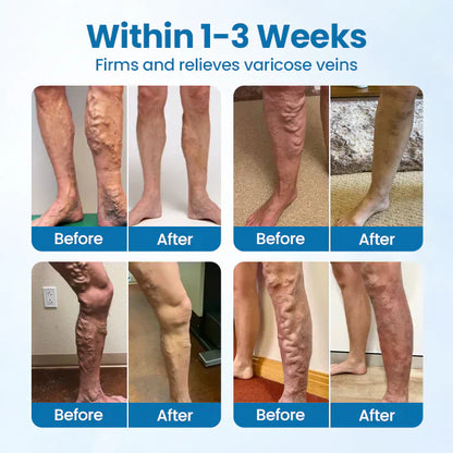 💪Ourlyard® VeinGuard Herbal Spray-✅ Clinically proven to eliminate varicose veins in just 7 days! (🔥Limited Time 80% OFF🔥)
