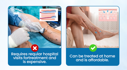 💪Ourlyard® VeinGuard Herbal Spray-✅ Clinically proven to eliminate varicose veins in just 7 days! (🔥Limited Time 80% OFF🔥)