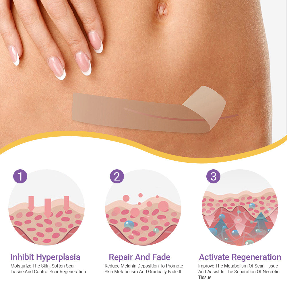 👨‍⚕️Official Store |Ourlyard® Hyaluronic Acid Nano Microneedle Repair Tape🏥(Treatment of old and new scars, reduction of surgical scars, stretch marks, keloids, acne, burns, warts, dermatomes and varicose veins)