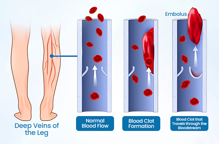 💪Ourlyard® VeinGuard Herbal Spray-✅ Clinically proven to eliminate varicose veins in just 7 days! (🔥Limited Time 80% OFF🔥)